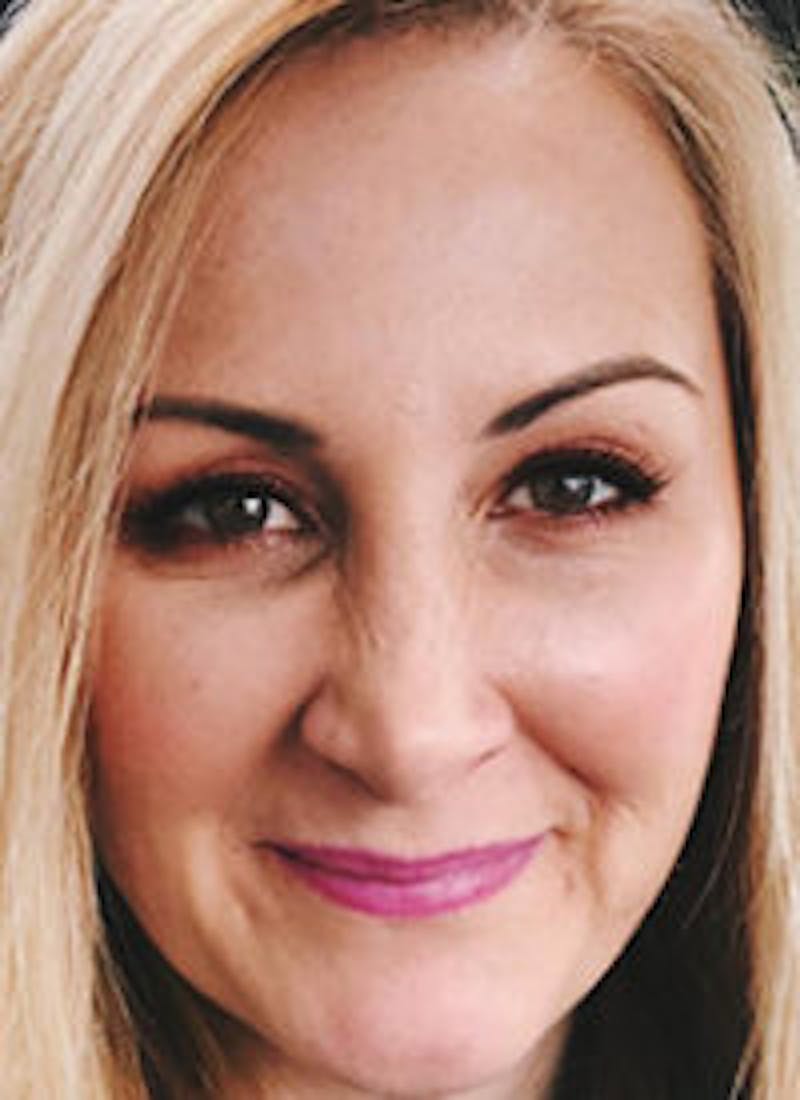 Liquid Face Lift Before & After Gallery - Patient 683280 - Image 2