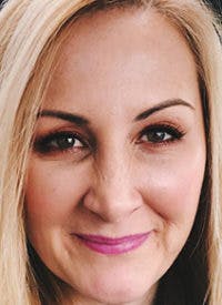 Liquid Face Lift Before & After Gallery - Patient 683280 - Image 2