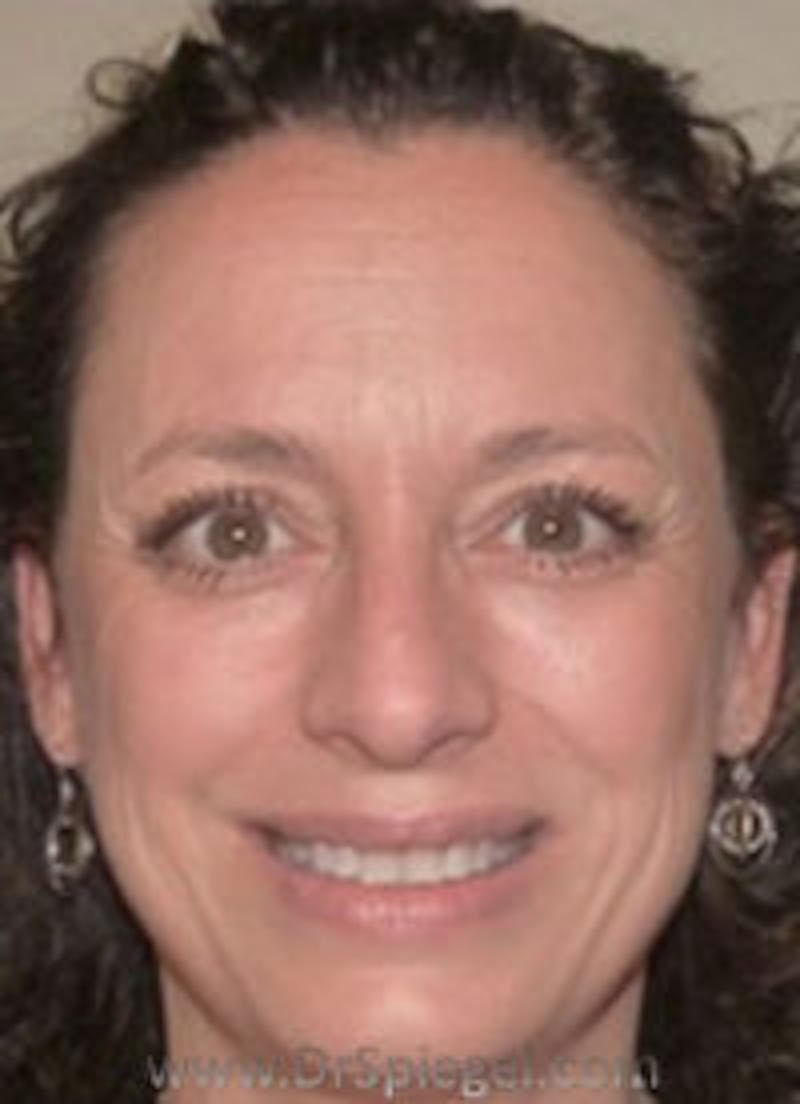 Liquid Face Lift Before & After Gallery - Patient 678302 - Image 1