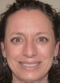 Liquid Face Lift Before & After Gallery - Patient 678302 - Image 1