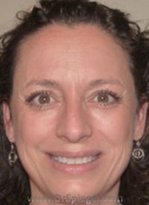 Liquid Face Lift Before & After Gallery - Patient 678302 - Image 1