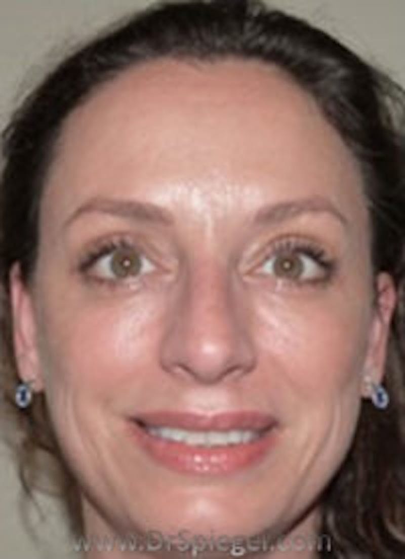 Liquid Face Lift Before & After Gallery - Patient 678302 - Image 2