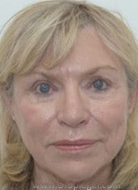 Liquid Face Lift Before & After Gallery - Patient 232093 - Image 1