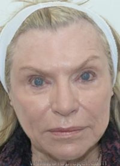 Liquid Face Lift Before & After Gallery - Patient 232093 - Image 2