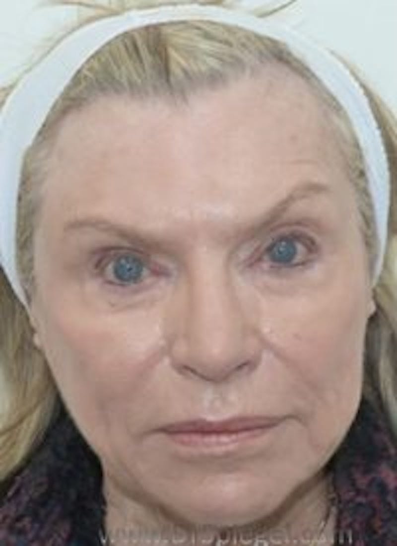 Liquid Face Lift Before & After Gallery - Patient 232093 - Image 2