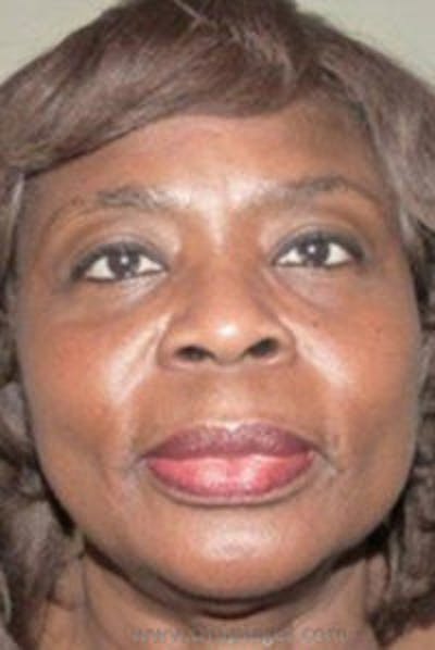 Liquid Face Lift Before & After Gallery - Patient 132112 - Image 1