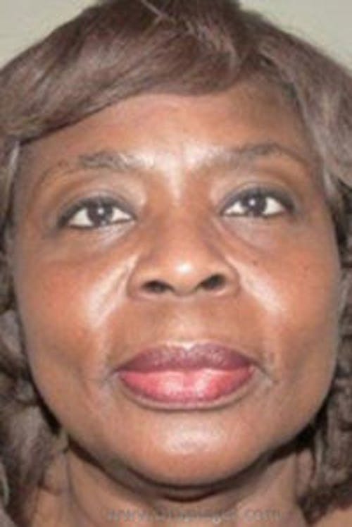 Liquid Face Lift Before & After Gallery - Patient 132112 - Image 1