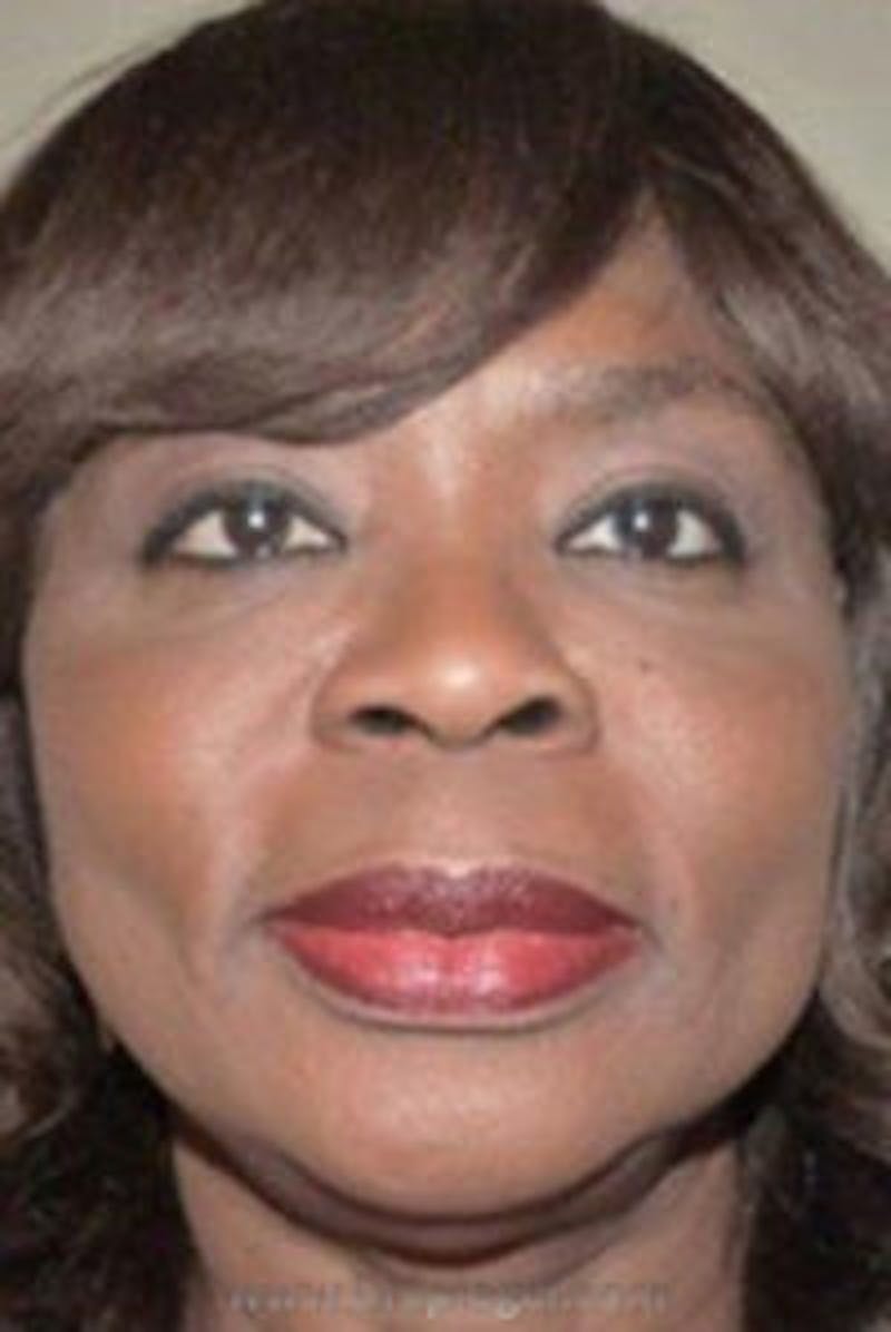 Liquid Face Lift Before & After Gallery - Patient 132112 - Image 2