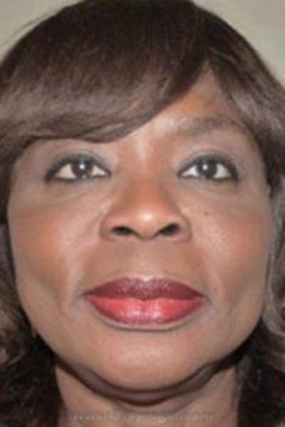 Liquid Face Lift Before & After Gallery - Patient 132112 - Image 2