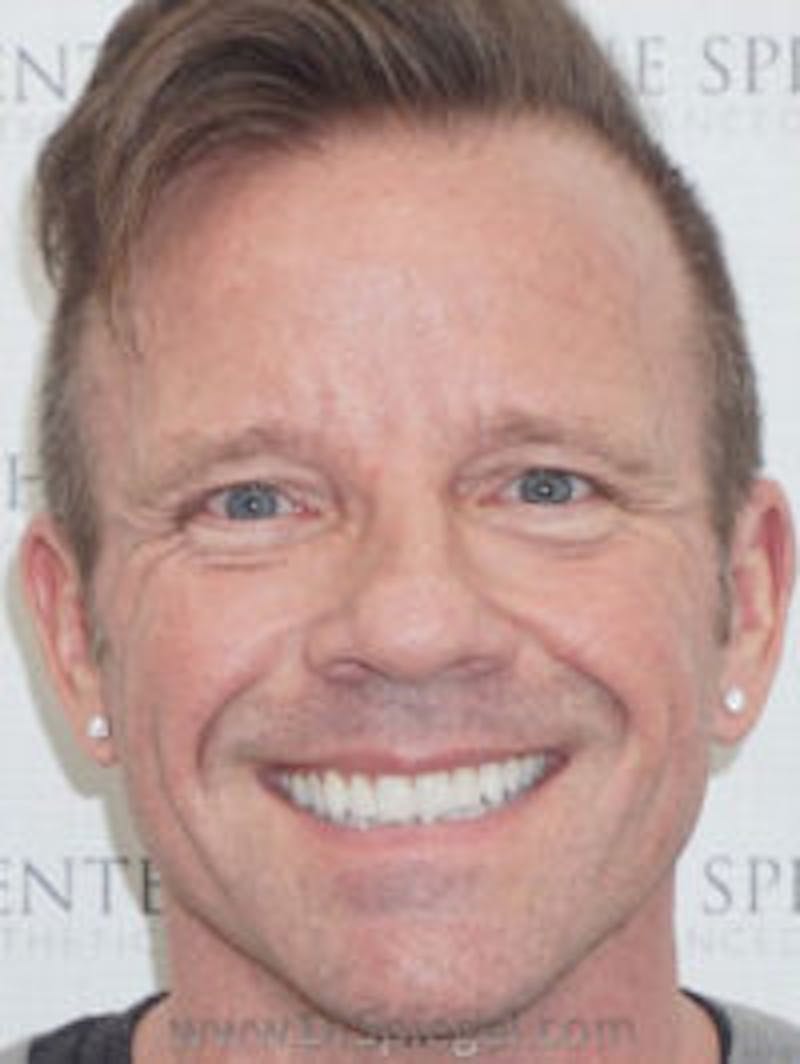 Liquid Face Lift Before & After Gallery - Patient 173409 - Image 1