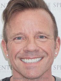 Liquid Face Lift Before & After Gallery - Patient 173409 - Image 1