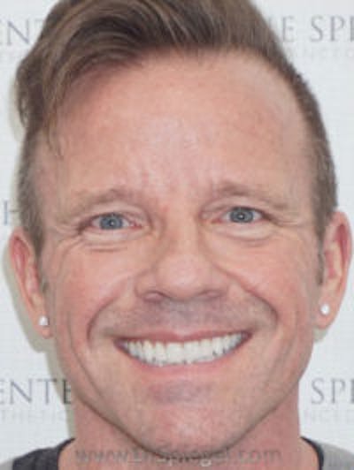 Liquid Face Lift Before & After Gallery - Patient 173409 - Image 1