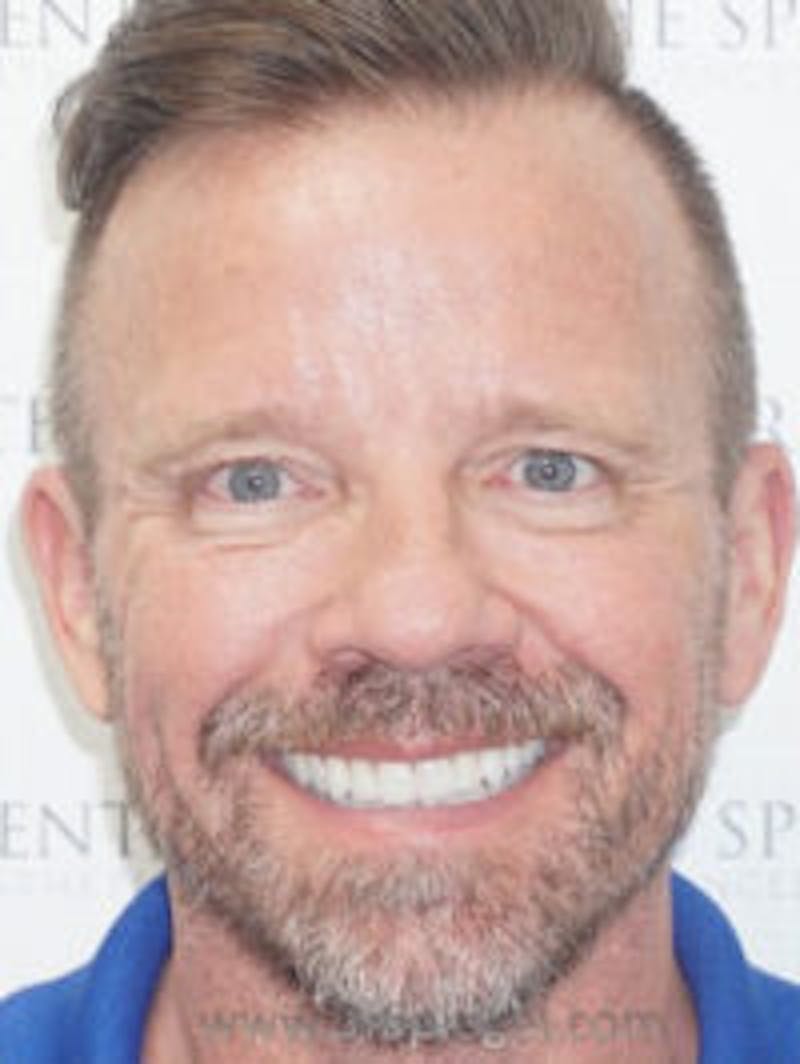 Liquid Face Lift Before & After Gallery - Patient 173409 - Image 2