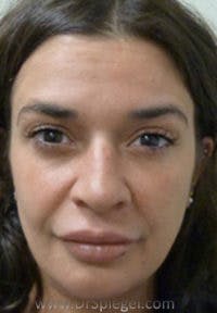 Liquid Face Lift Before & After Gallery - Patient 117098 - Image 1