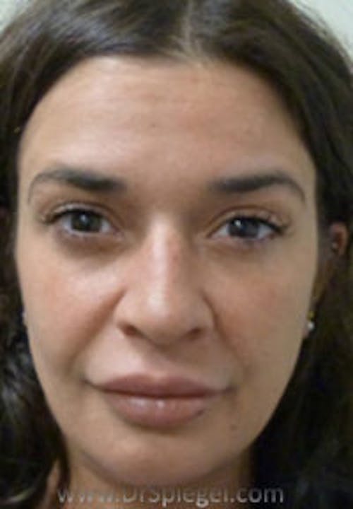 Liquid Face Lift Before & After Gallery - Patient 117098 - Image 1