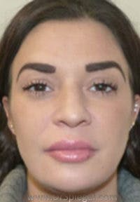 Liquid Face Lift Before & After Gallery - Patient 117098 - Image 2