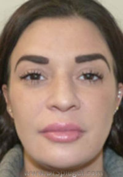 Liquid Face Lift Before & After Gallery - Patient 117098 - Image 2