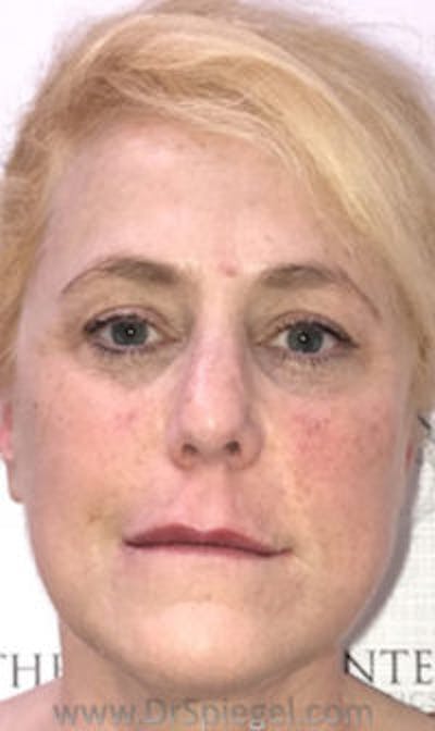 Liquid Face Lift Before & After Gallery - Patient 109216 - Image 1
