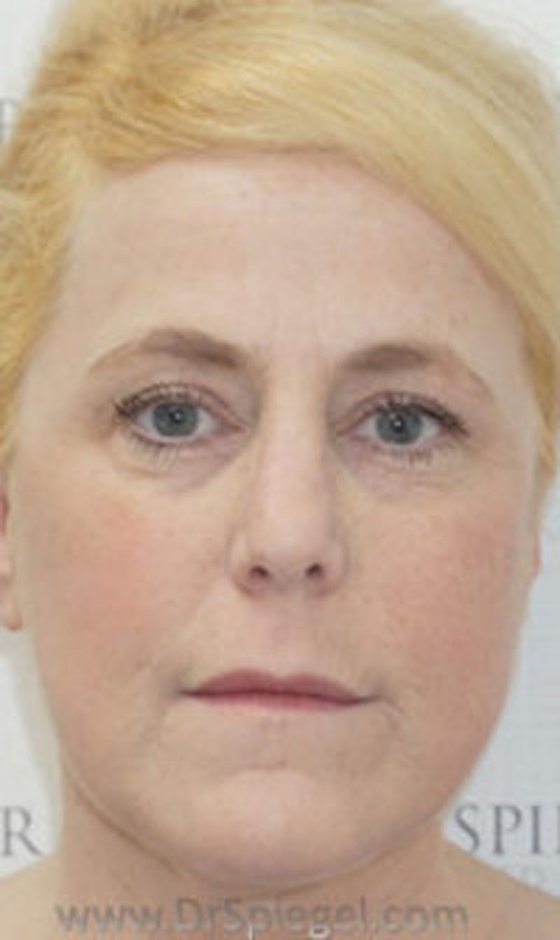 Liquid Face Lift Before & After Gallery - Patient 109216 - Image 2