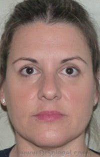 Liquid Face Lift Before & After Gallery - Patient 189699 - Image 2