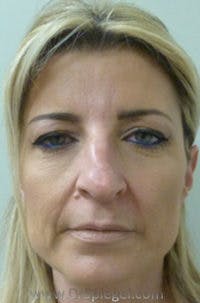 Liquid Face Lift Before & After Gallery - Patient 195916 - Image 1