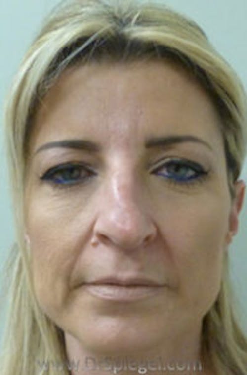 Liquid Face Lift Before & After Gallery - Patient 195916 - Image 1