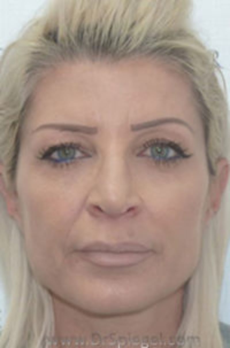 Liquid Face Lift Before & After Gallery - Patient 195916 - Image 2