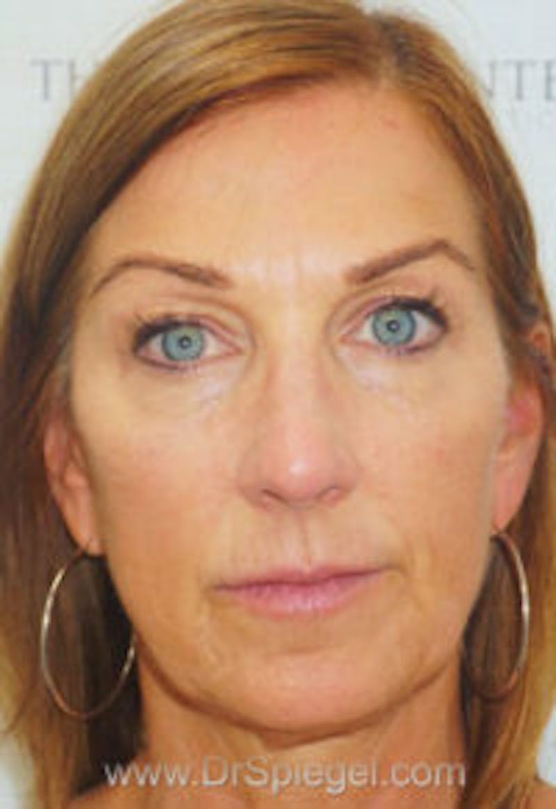 Liquid Face Lift Before & After Gallery - Patient 182710 - Image 2