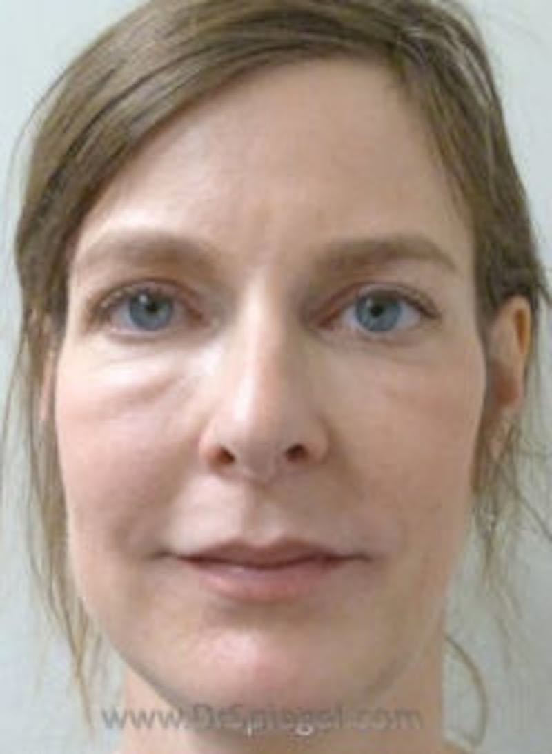 Liquid Face Lift Before & After Gallery - Patient 128437 - Image 1
