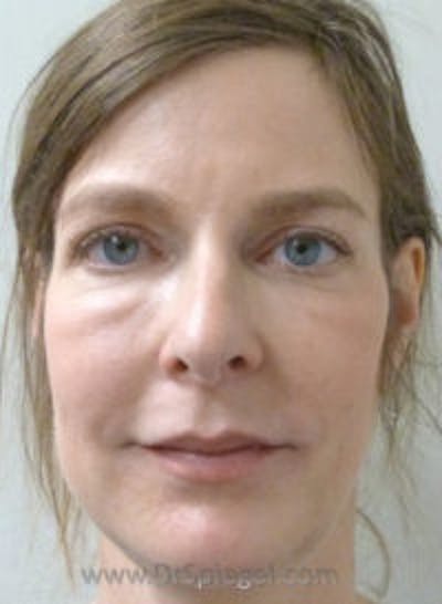 Liquid Face Lift Before & After Gallery - Patient 128437 - Image 1