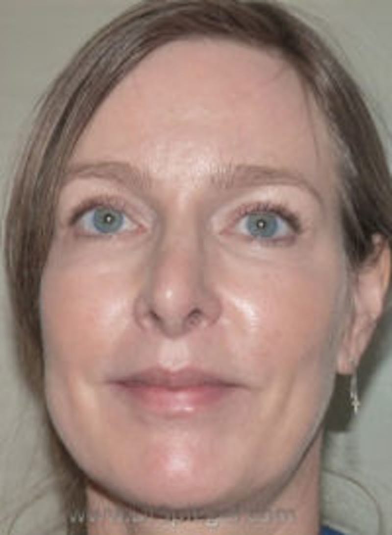 Liquid Face Lift Before & After Gallery - Patient 128437 - Image 2