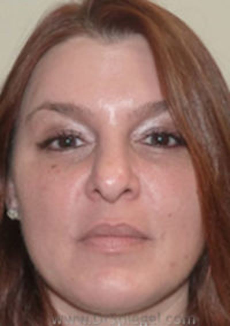 Liquid Face Lift Before & After Gallery - Patient 242866 - Image 2