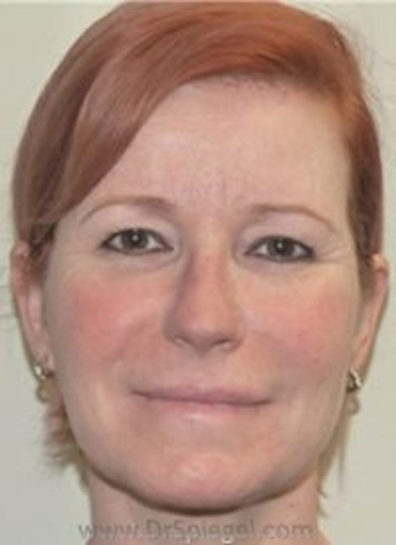 Liquid Face Lift Before & After Gallery - Patient 378065 - Image 1