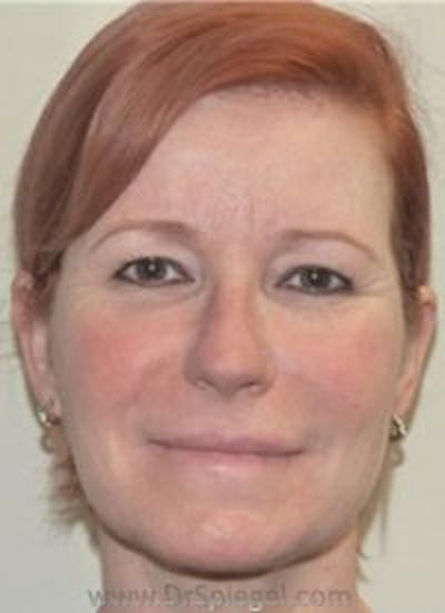 Liquid Face Lift Before & After Gallery - Patient 378065 - Image 1