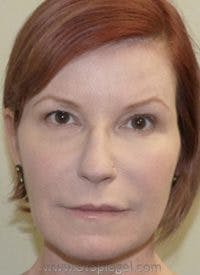 Liquid Face Lift Before & After Gallery - Patient 378065 - Image 2
