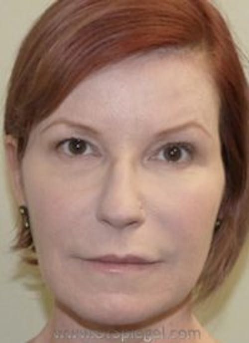 Liquid Face Lift Before & After Gallery - Patient 378065 - Image 2
