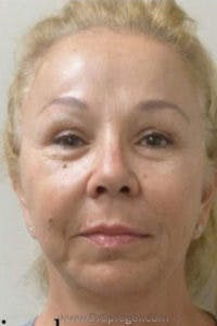 Liquid Face Lift Before & After Gallery - Patient 211786 - Image 2