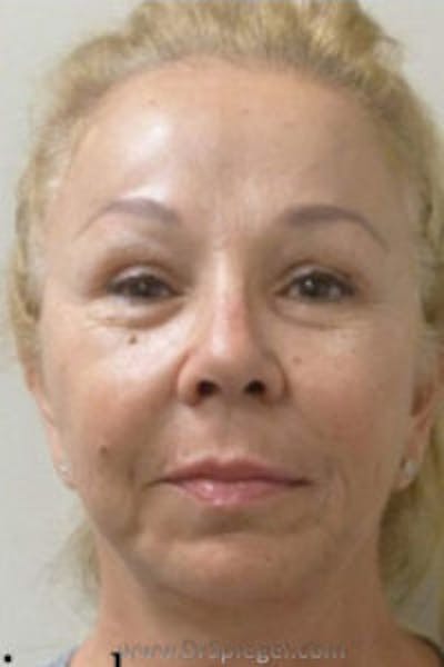 Liquid Face Lift Before & After Gallery - Patient 211786 - Image 2