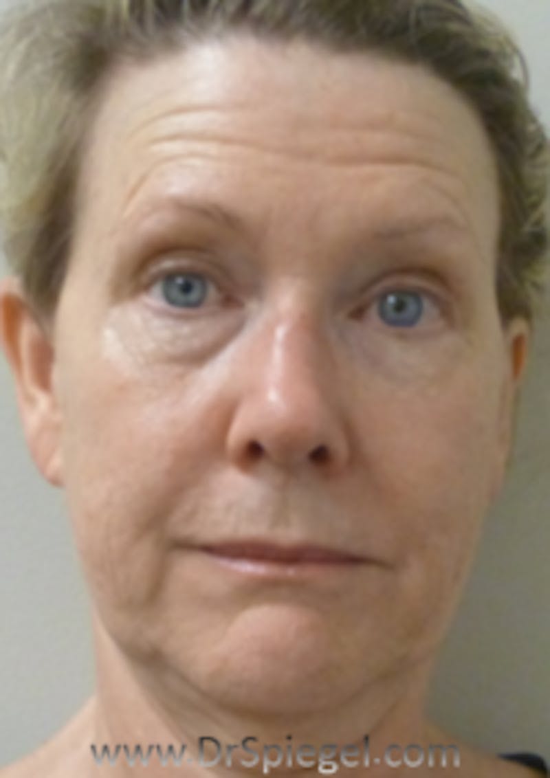 Liquid Face Lift Before & After Gallery - Patient 160988 - Image 1