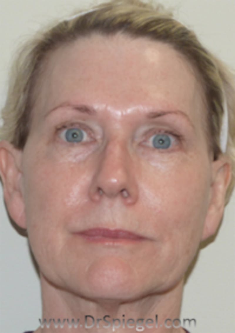 Liquid Face Lift Before & After Gallery - Patient 160988 - Image 2