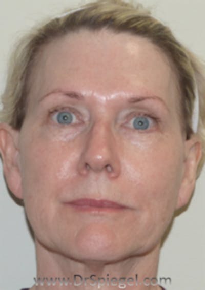 Liquid Face Lift Before & After Gallery - Patient 160988 - Image 2