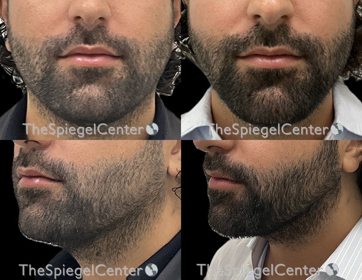 Mandible Jaw Filler Before & After Gallery - Patient 215592 - Image 1