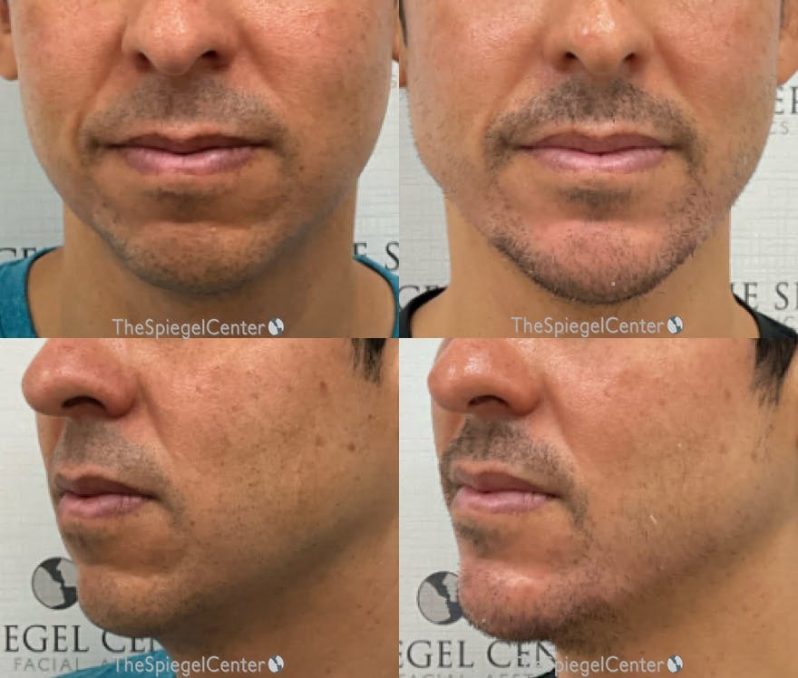 Mandible Jaw Filler Before & After Gallery - Patient 399300 - Image 1