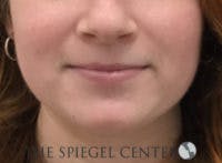 Mandible Jaw Filler Before & After Gallery - Patient 211672 - Image 1