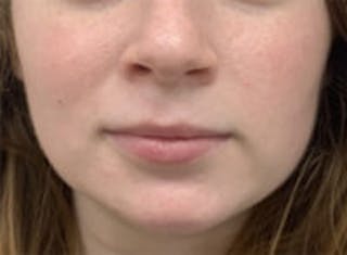 Mandible Jaw Filler Before & After Gallery - Patient 211672 - Image 2