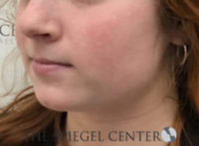 Mandible Jaw Filler Before & After Gallery - Patient 211672 - Image 3