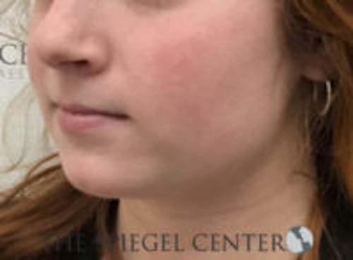 Mandible Jaw Filler Before & After Gallery - Patient 211672 - Image 3
