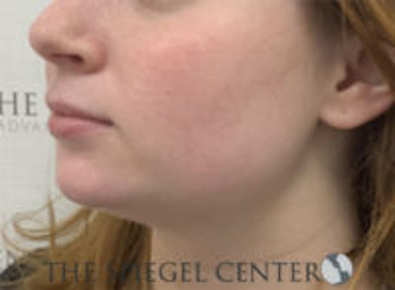 Mandible Jaw Filler Before & After Gallery - Patient 211672 - Image 4