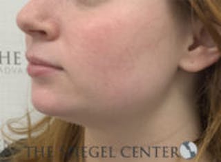 Mandible Jaw Filler Before & After Gallery - Patient 211672 - Image 4
