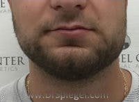 Mandible Jaw Filler Before & After Gallery - Patient 115525 - Image 1